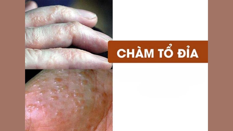 Hình ảnh bệnh chàm tổ đỉa và dấu hiệu dễ nhận biết