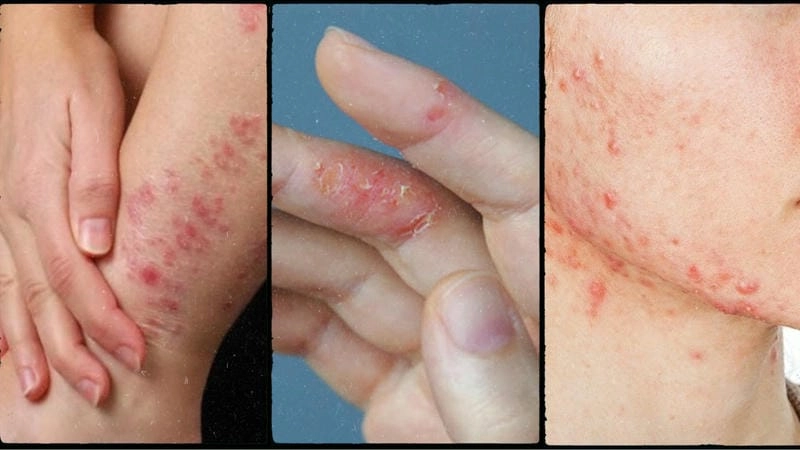 Tổng hợp chi tiết chàm to đỉa ảnh bệnh thường gặp