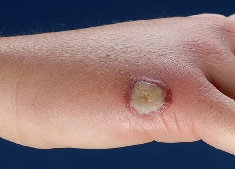 Cảnh báo sớm bệnh chốc chàm hoá da