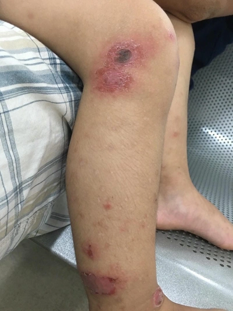 Cẩn trọng với bệnh chốc da ở trẻ em