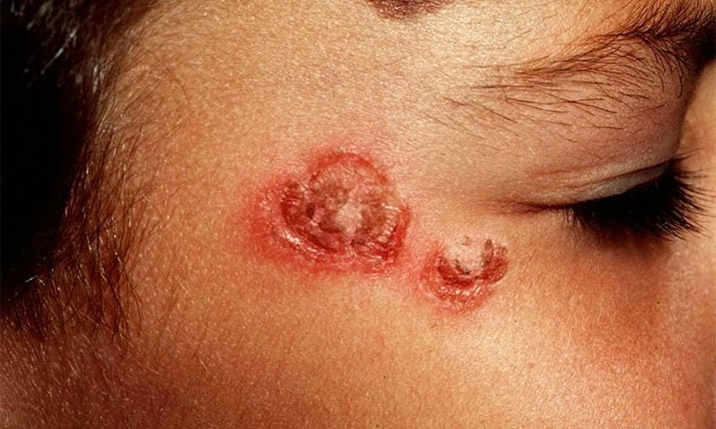 Đừng bỏ qua bệnh chốc loét ở trẻ em