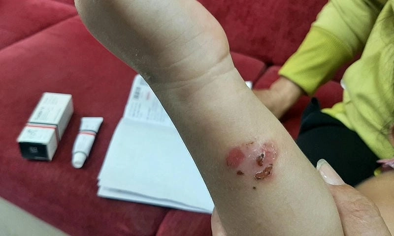 Phân biệt hình ảnh bệnh chốc khi bị bệnh chốc lở ở trẻ em