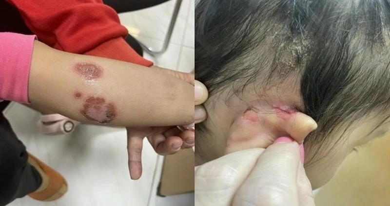 Xem rõ hình ảnh bệnh chốc khi bị chốc ở trẻ em