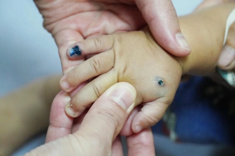 Hình ảnh bệnh chốc khi bị chốc ở trẻ dễ lan rộng