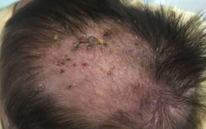 Triệu chứng dễ nhận qua hình ảnh bệnh chốc đầu