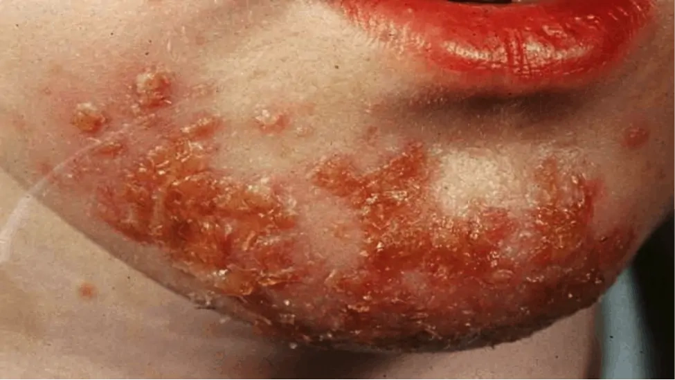 Dễ phát hiện qua hình ảnh bệnh chốc ở trẻ giai đoạn đầu