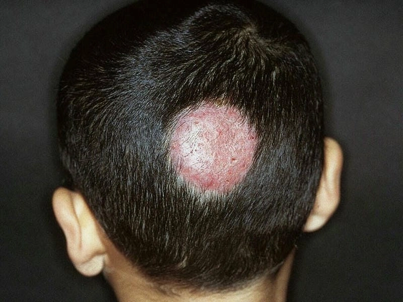 Cập nhật hình ảnh bệnh chốc đầu mới nhất