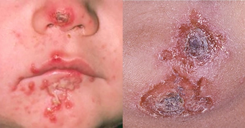 Phân biệt nhanh hình ảnh bệnh chốc lở