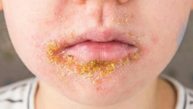 Cách xử lý khi mắc bệnh chóc lở nhẹ