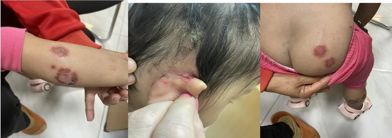 Xem ngay hình ảnh bị chốc lở để nhận biết sớm