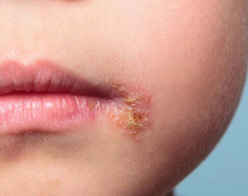 Cách xử lý nhanh khi trẻ mắc bệnh chốc lở ở trẻ