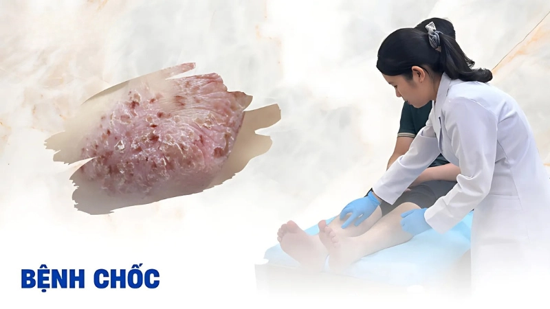 Hình ảnh bệnh chốc thường gặp ở trẻ em và người lớn