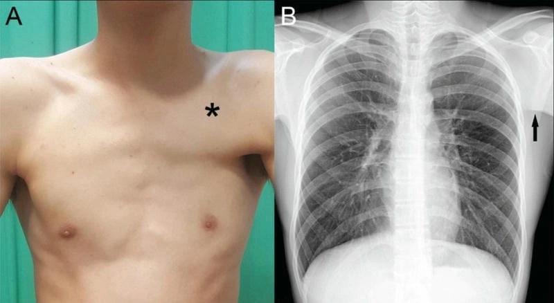 Ảnh còi xương minh họa triệu chứng ở tay chân trẻ nhỏ