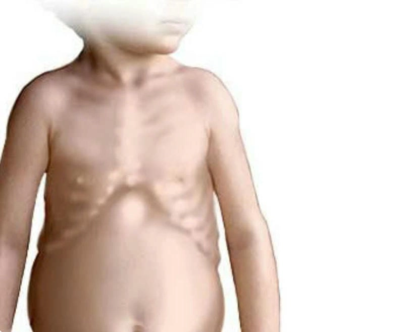 Ảnh bệnh còi xương giúp nhận biết dấu hiệu thiếu canxi