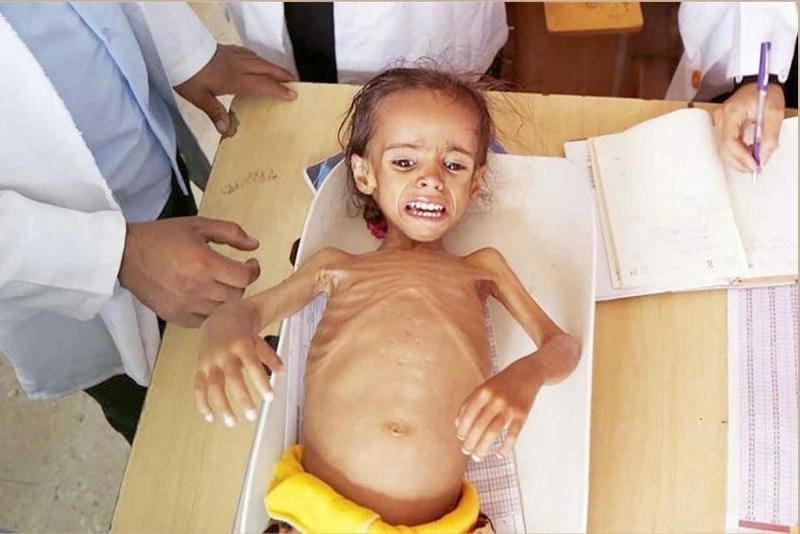 Hình ảnh bé bị còi xương cho thấy xương biến dạng rõ rệt