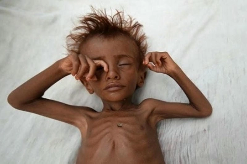 Hình ảnh còi xương giúp chẩn đoán tình trạng thiếu vitamin D