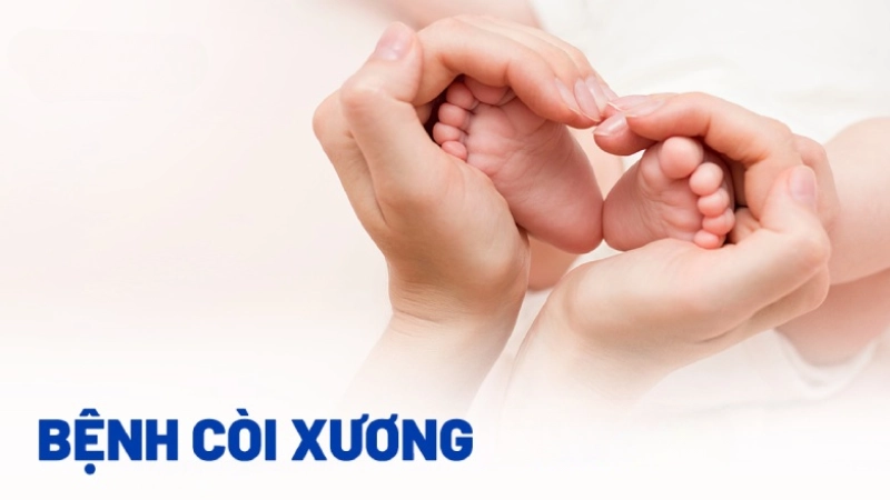 Hình ảnh bệnh còi xương điển hình giúp phụ huynh dễ nhận ra