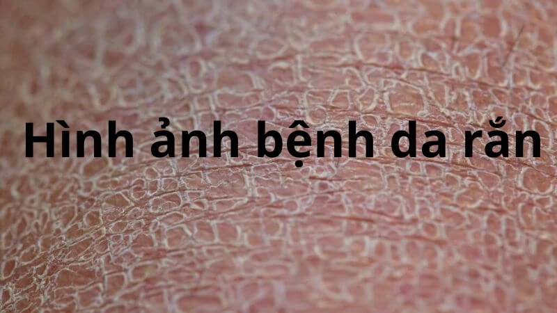 Bộ sưu tập hình ảnh bệnh da rắn dễ nhận biết tại nhà