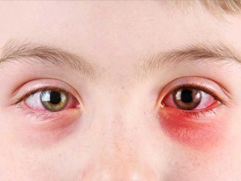 Xem ảnh trẻ đau mắt hột để kịp thời phát hiện