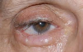 Cảnh giác đau mắt hột ở trẻ em vào mùa hè