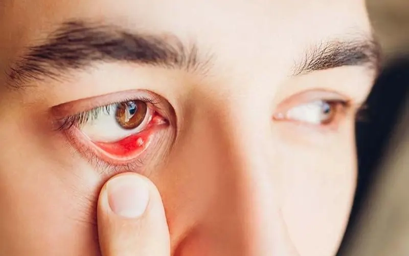 Tổng hợp đau mắt hột ảnh bệnh cho người tìm hiểu
