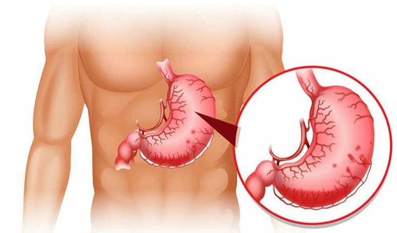 Đừng chủ quan nếu bạn bị đau dạ dày