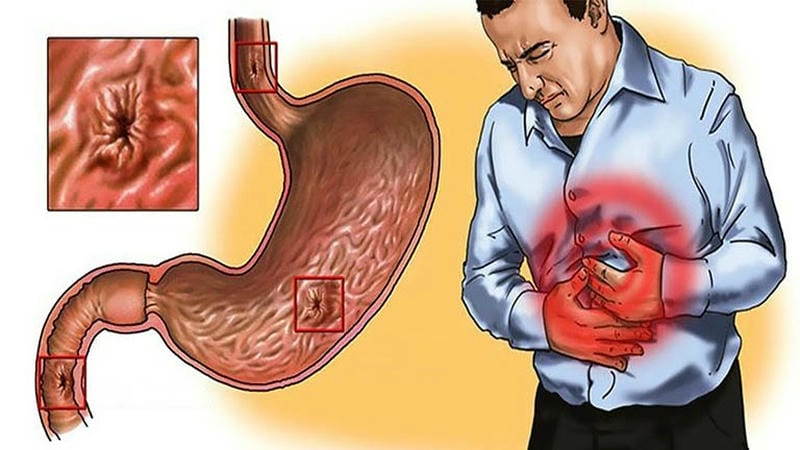 Phát hiện sớm dấu hiệu đau dạ dày cấp