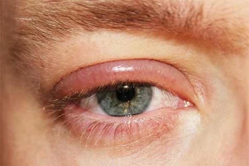 Đau mắt đỏ làm mờ mắt gây khó chịu khi nhìn gần