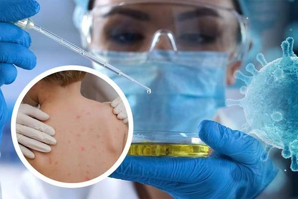 Nhận biết bệnh nhanh với hình ảnh đậu mùa khỉ chính xác
