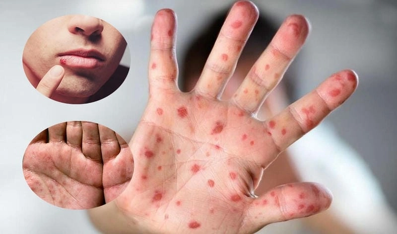 Cập nhật hình đậu mùa khỉ để phòng bệnh hiệu quả