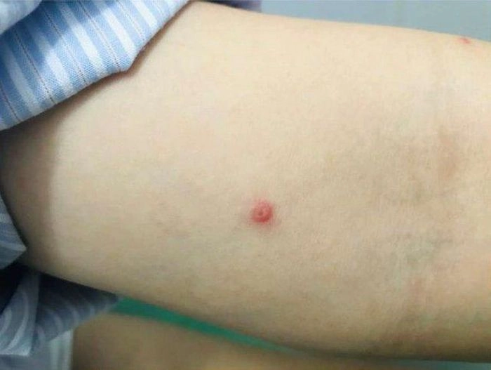 Tìm hiểu sức khỏe qua hình ảnh đậu mùa từ bác sĩ