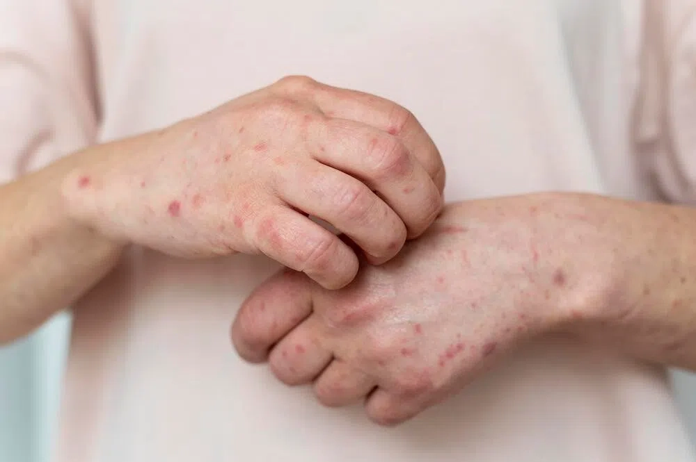 Hiểu rõ hình ảnh về bệnh đậu mùa khỉ để phòng tránh