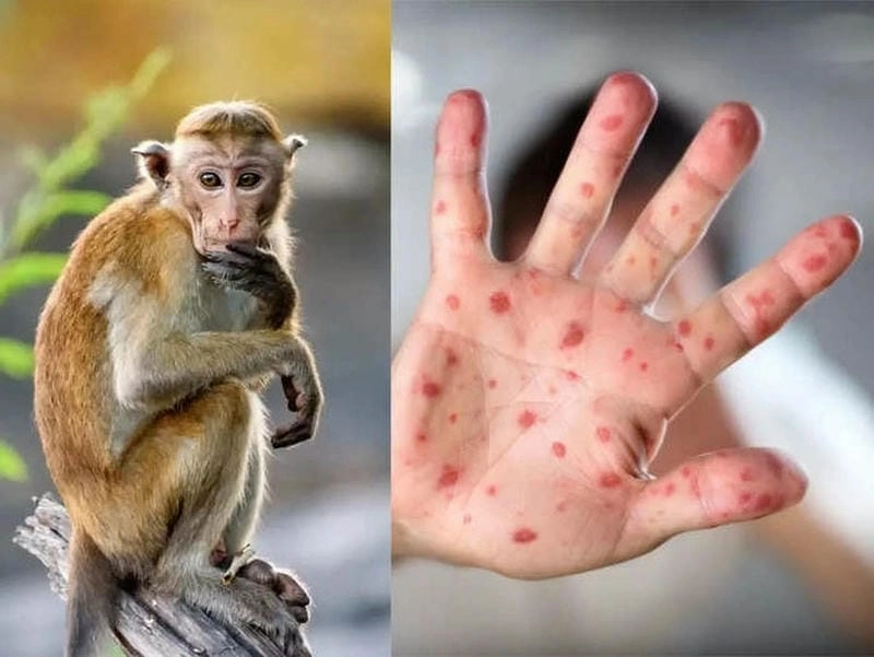 Thông tin bệnh đậu mùa khỉ kèm hình ảnh minh họa