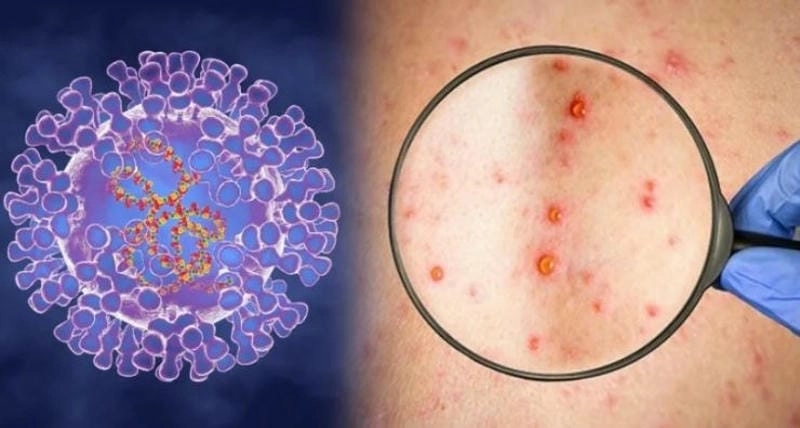 Xem hình ảnh bị bệnh đậu mùa khỉ cảnh báo cộng đồng