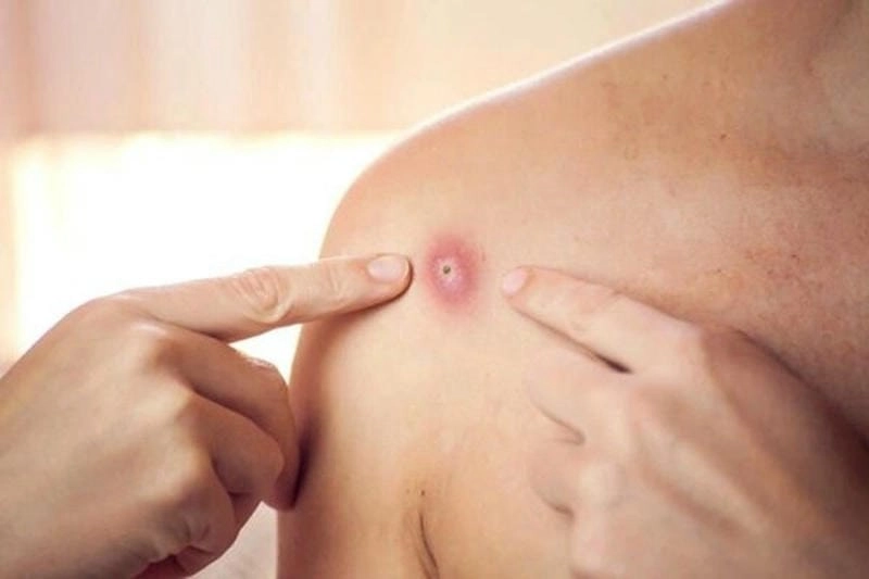 Cảnh báo tình hình bệnh đậu mùa khỉ đáng chú ý