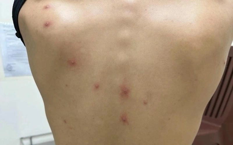 Cập nhật liên tục tình hình dịch đậu mùa khỉ trên thế giới