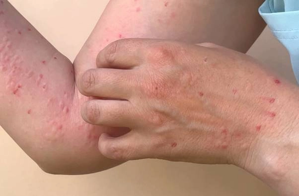 Phân biệt triệu chứng nhờ hình ảnh bệnh đậu mùa và hình ảnh bệnh đậu mùa khỉ