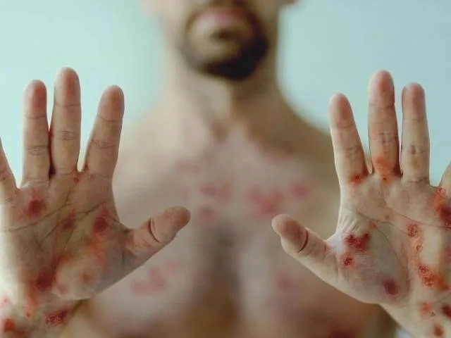 Nhận biết dấu hiệu qua hình ảnh bệnh đậu mùa và hình ảnh bệnh đầu mùa khỉ