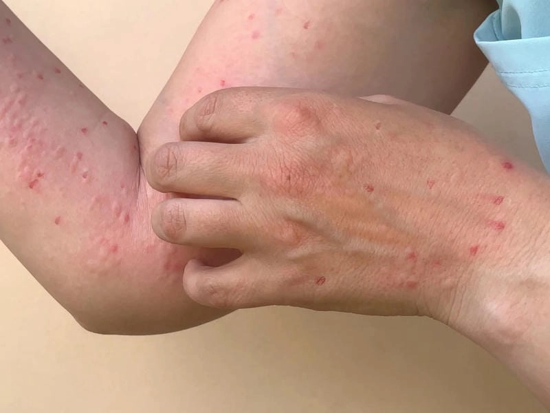 Theo dõi hình ảnh bệnh đậu mùa để hiểu rõ tình hình đậu mùa khỉ