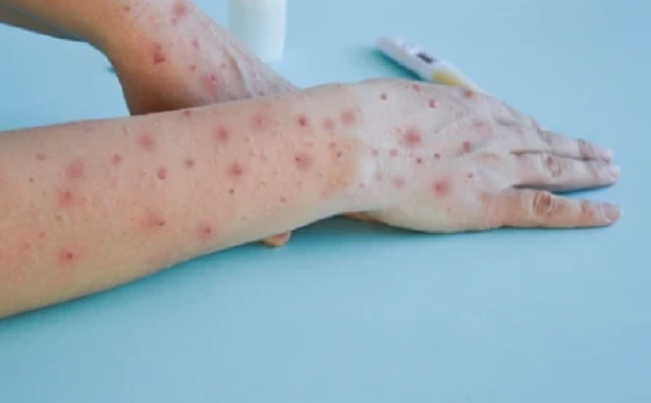 Chia sẻ bộ sưu tập hình ảnh bệnh đậu mùa gồm nhiều ảnh đậu mùa khỉ