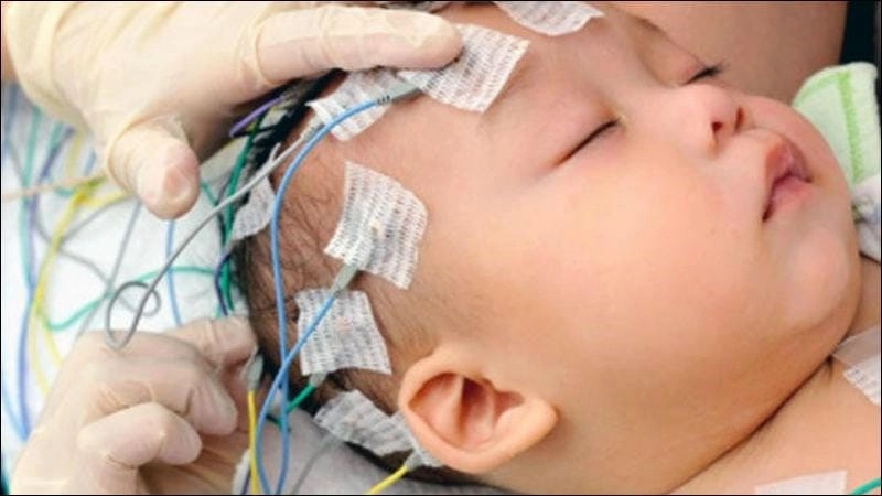 Hình ảnh minh họa động kinh cơn lớn dễ nhận biết