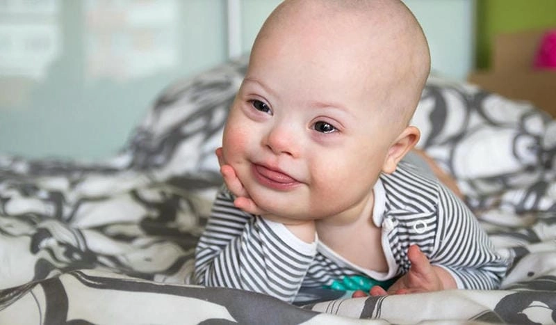 Xem ngay hình ảnh bệnh đao ở trẻ em