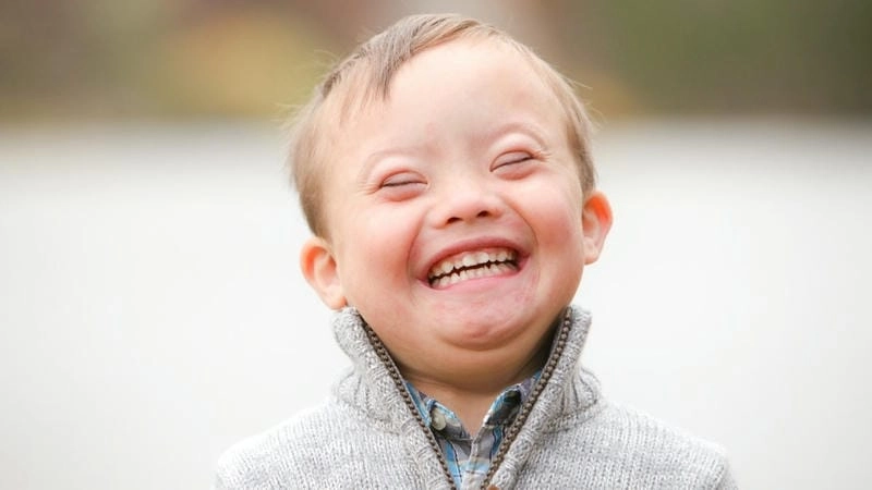 Biểu hiện của bệnh down nhẹ thường gặp