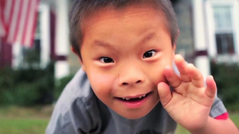 Nhận biết sớm bệnh down ở trẻ sơ sinh