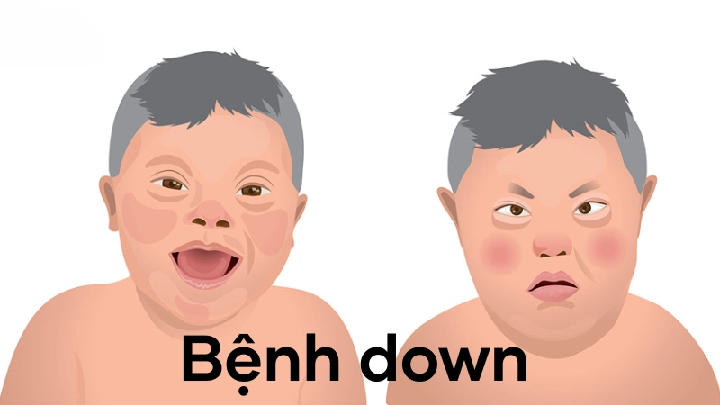 Dấu hiệu đặc trưng qua hình ảnh bệnh Down thực tế