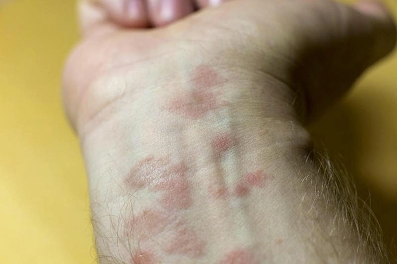 Tài liệu minh họa ảnh người bị bệnh eczema chi tiết