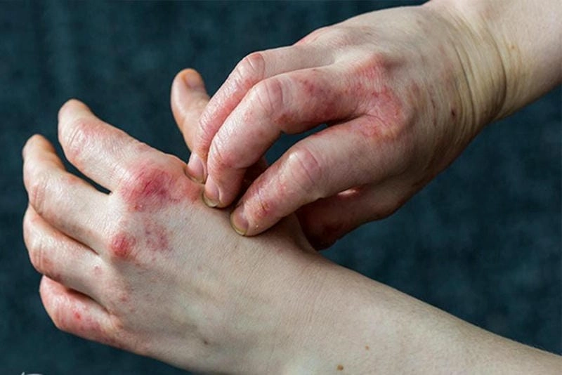 Triệu chứng eczema tiếp xúc được ghi lại bằng ảnh