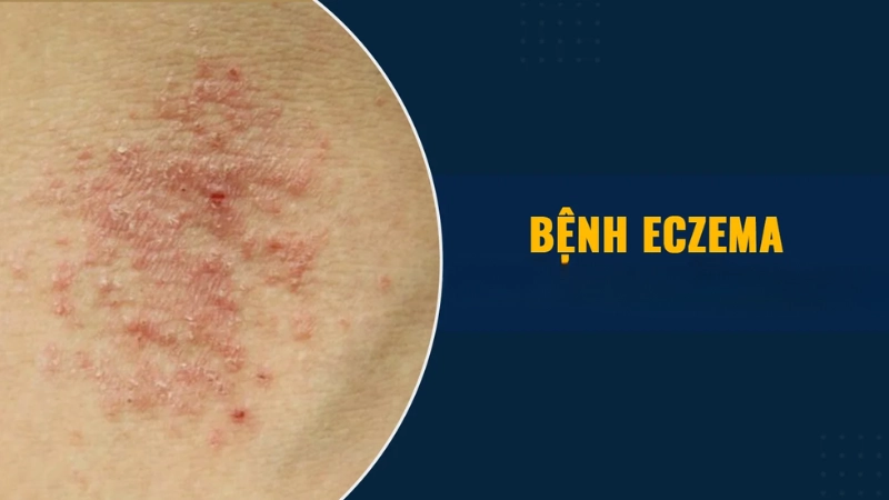 Nhận biết sớm qua hình ảnh bệnh eczema theo từng giai đoạn