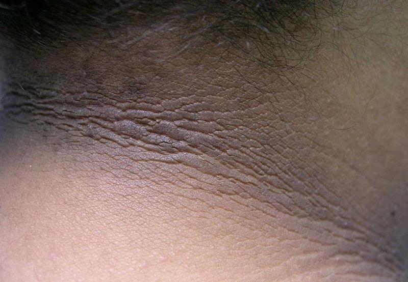 Cách xử lý khi bị gai đen ở cổ không để lại sẹo