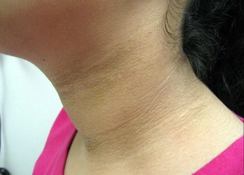 Xem ngay hình ảnh bệnh gai đen ở cổ rõ nét dễ hiểu